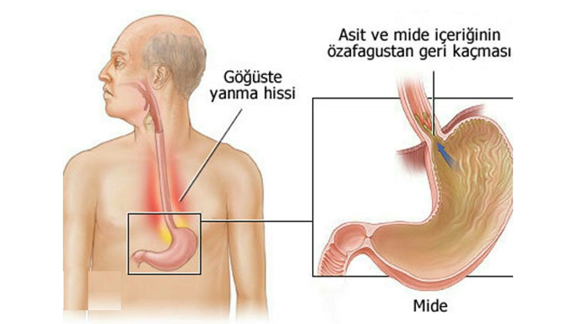 Erkekte Göğüste Şişlik Erkekte Göğüste Şişlik